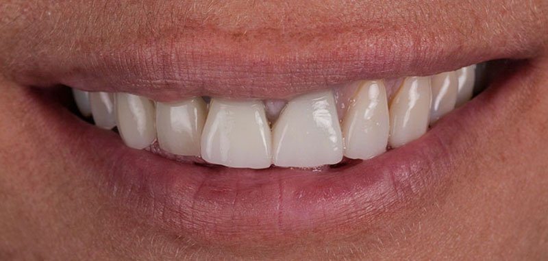 SONRISA-antes-alicia2