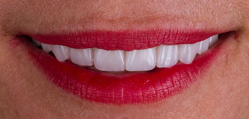 SONRISA-despues-alicia