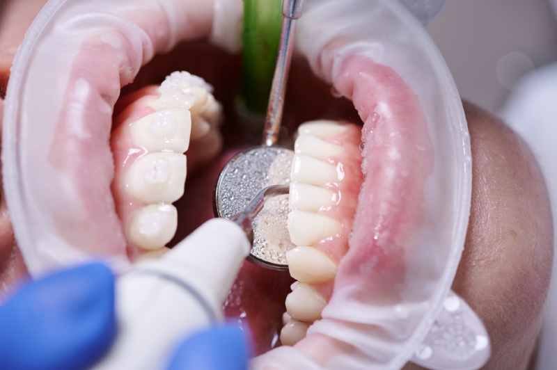Dientes picados: consejos para evitar el avance de la caries