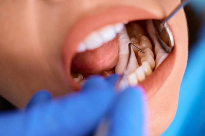 Tratamientos para los dientes picados