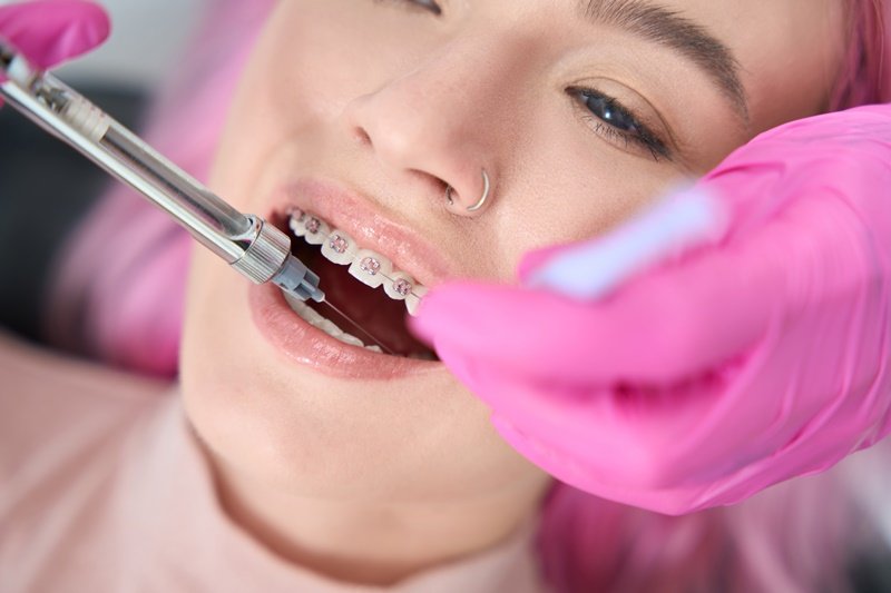 Cuánto dura la anestesia del dentista y por qué varía su duración