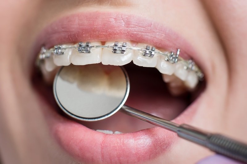 Tipos de ortodoncia: brackets metálicos