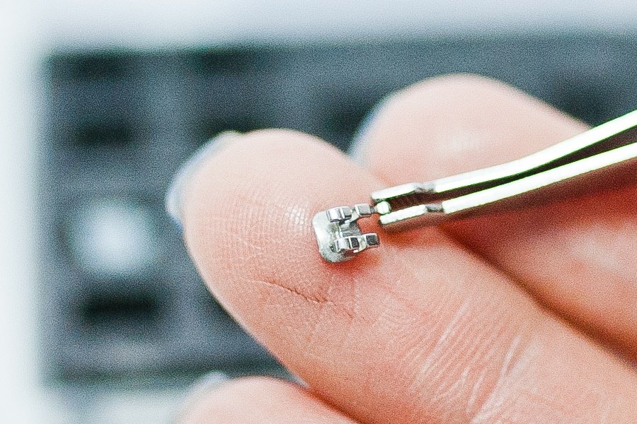 Ortodoncia en las muelas: los brackets en las muelas son esenciales para garantizar que el tratamiento ortodóntico sea efectivo