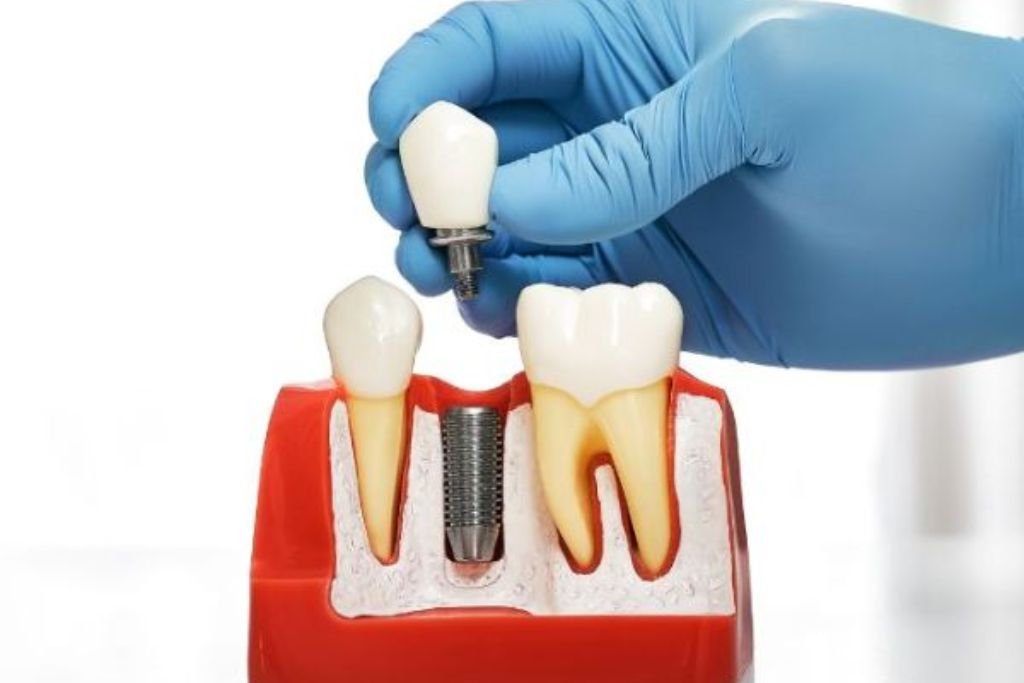 Explantación implante Vigo