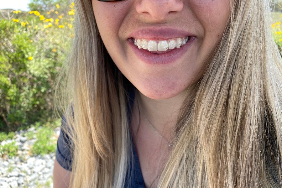 Los alineadores transparentes de la ortodoncia invisible son prácticamente imperceptibles, ideales para un tratamiento más estético.