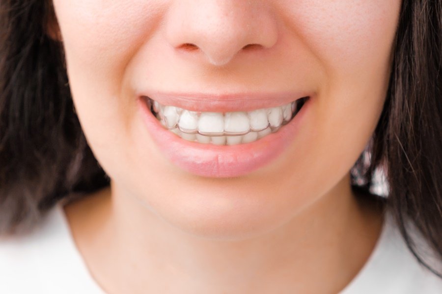 A diferencia de los brackets tradicionales, los alineadores transparentes de la ortodoncia invisible son removibles y casi imperceptibles.