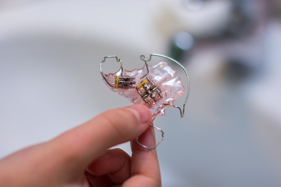 El expansor palatino trabaja aplicando una presión suave pero constante sobre el maxilar superior, lo que provoca la separación gradual de las dos mitades del paladar.