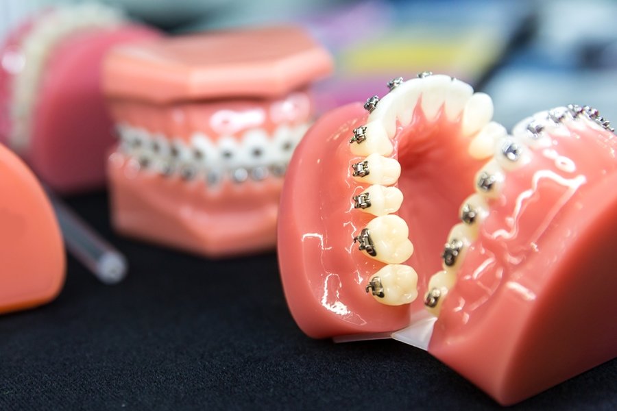 El tratamiento de ortodoncia es la opción más común para corregir la maloclusión dental, porque mueve los dientes a su posición adecuada y corrige problemas de mordida.