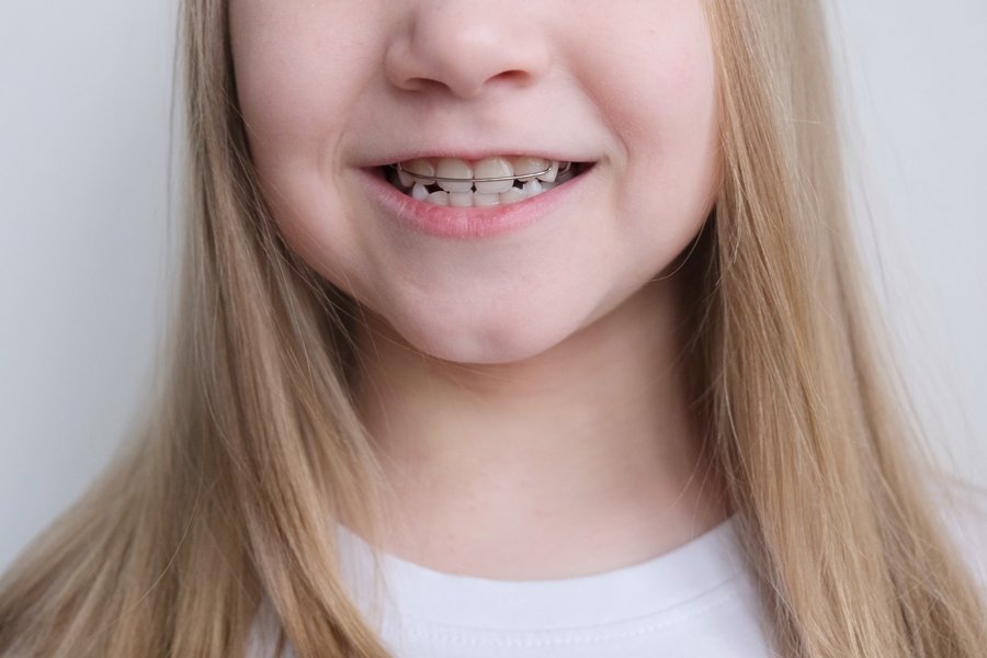 Tratamiento con ortodoncia interceptiva en una niña para corregir alteraciones dentales en etapa de crecimiento