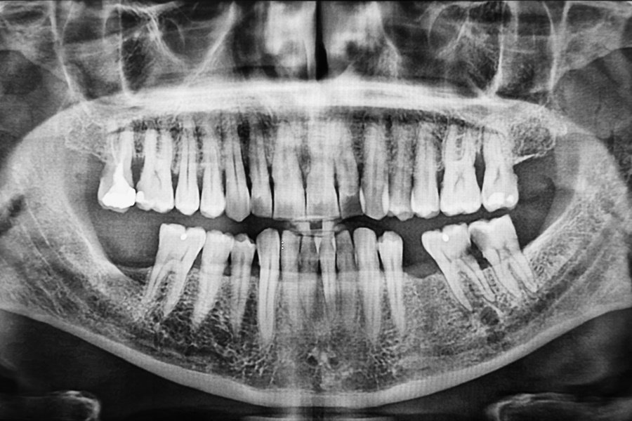 Radiografía panorámica de un paciente con varias ausencias dentales, muestra qué ocurre cuando no se reemplazan las piezas dentales perdidas.