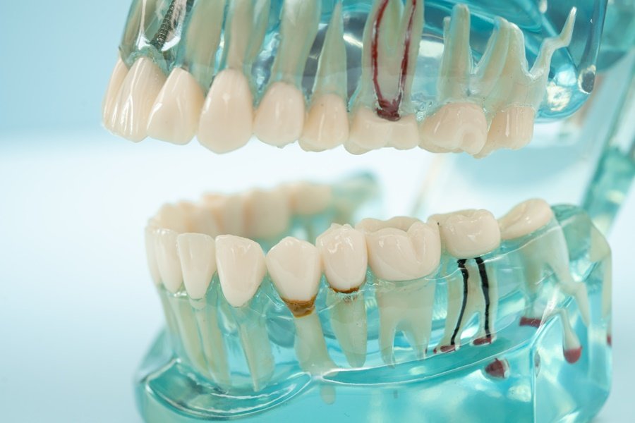 Modelo dental con dientes y raíces visibles utilizado para explicar un traumatismo dental.