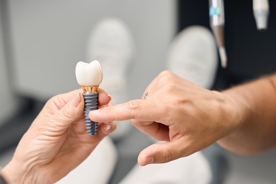 Manos de odontólogo y paciente sosteniendo un modelo de implante dental para explicar de forma visual qué es un implante cigomático y su función en casos con pérdida ósea.